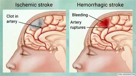 A Primer On Strokes And The Warning Signs To Watch For Cbc Life
