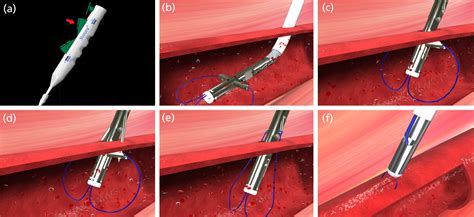 An Overview Of Vascular Closure Devices What Every Radiologist Should