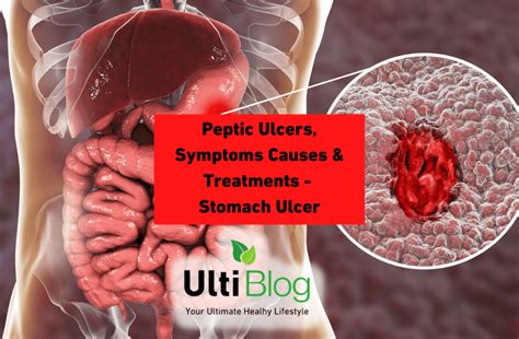 Stomach Ulcer Causes And Treatments Peptic Ulcers Atoallinks