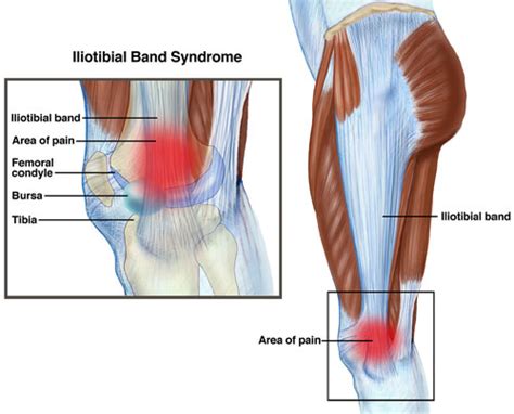 Physical Therapist S Guide To Iliotibial Band Syndrome ITBS Or IT