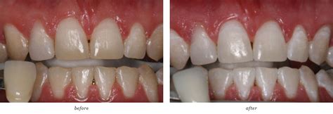 Whitening Gallery West Ashley Dental Associates