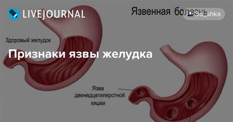 Симптомы язвы желудка диета Язва признаки симптомы: Язвенная болезнь желудка - симптомы Язва признаки симптомы: Язвенная болезнь желудка - симптомы Симптомы язвы желудка диета