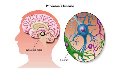 Parkinson tratamente naturiste cauze și simptome Doftoria ro