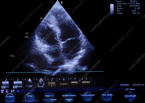 Heart Ultrasound Scan Stock Image C0098335 Science Photo Library