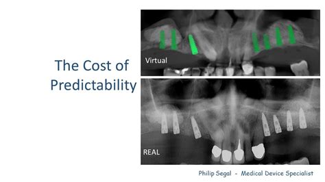 Guided Surgery In The Partially Edentulous Maxilla