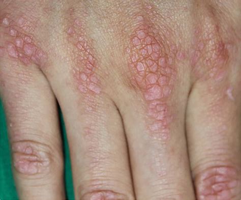 Erythematous Papules On Dorsum Of Both Hands Aafp