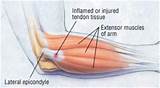 Tendonitis Therapy Pictures