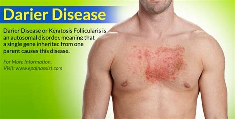 Darier Disease Or Keratosis Follicularis Treatment Causes Symptoms