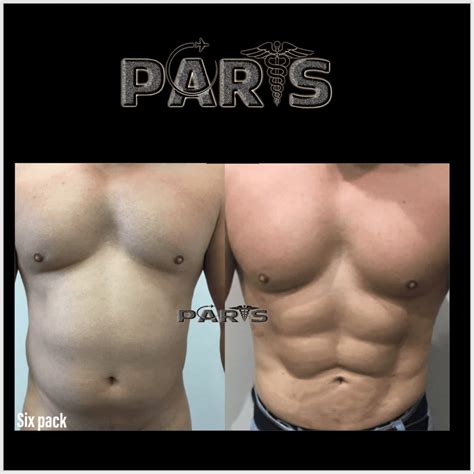 abdominal etching 6 pack paris health clinic