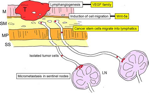 Frontiers Significance Of Lymph Node Metastasis In The Treatment Of
