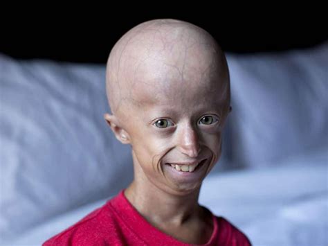 Progeria Premature Aging Syndrome What It Is Symptoms Causes