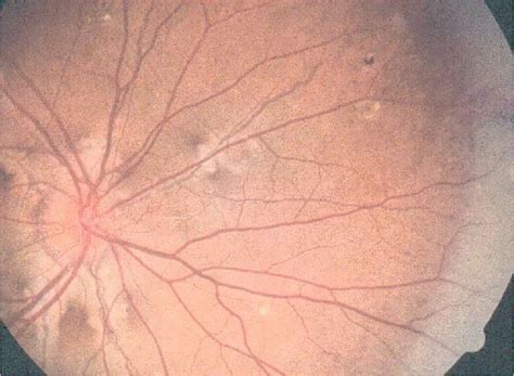 Characteristic Ophthalmological Feature Of Pxe Angioid Streaks On The