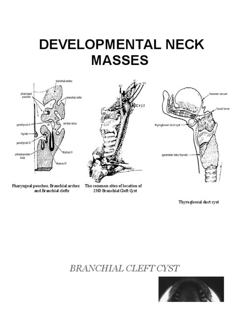 Developmental Neck Masses