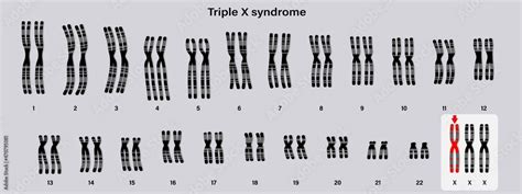 Human Karyotype Of Triple X Syndrome Xxx Female Has An Extra X Chromosome Vector De Stock