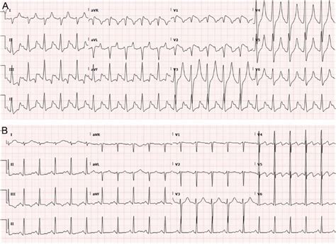 A Twelve Lead Ecg On Admission Of A Patient With Severe Dka Showing