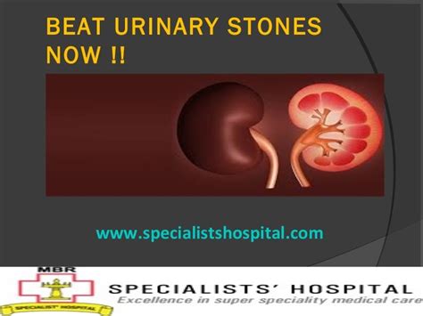 Urinary Stones Treatment Your Ultimate Guide