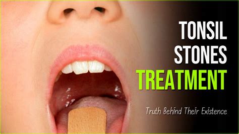 Tonsil Stones The Truth Behind Their Existence And How To Treat Them