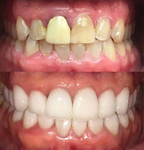 Pineview Dental Care Cosmetic Before And After In Morgantown