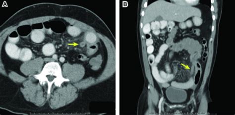 Figure 2left Sided Appendicitis In A Patient With Congenital
