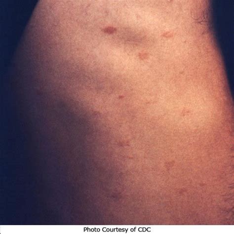 Pityriasis Rosea Stages Photos Treatments