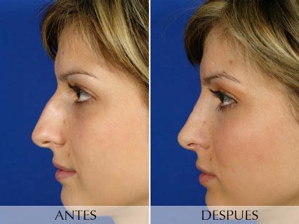 Eiza gonzález reyna (born 30 january 1990) is a mexican actress and singer. Alfonso GONZALEZ CEPEDA - Google+ | Rhinoplasty nose jobs ...