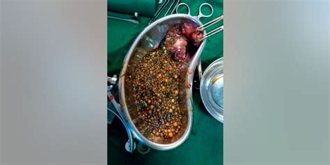 Surgeons Amazed After Removing Over 2000 Gallstones From Woman Fox News
