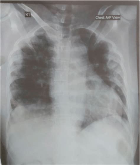 Chest X Ray Posterior Anterior View On Admission24 June 2020 Showing