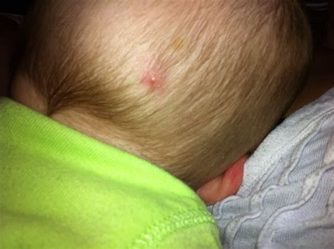 Pimple On Babys Head New Kids Center