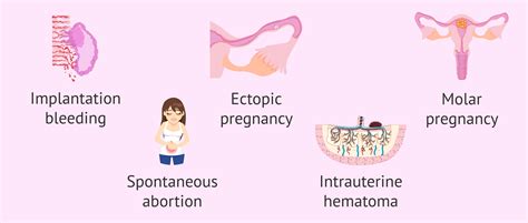 Causes Of Bleeding In The First Trimester Of Pregnancy