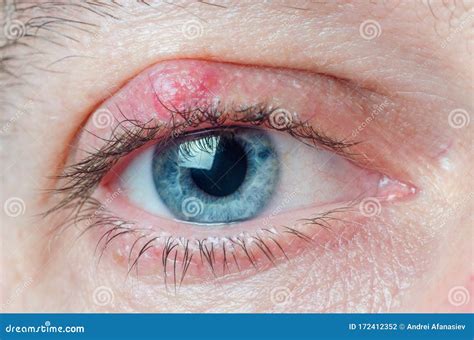 Chalazion On The Eyelid Of A Man Close Up Stock Photo Image Of Macro