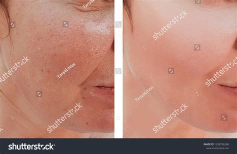 Woman Wrinkles Face Before After Procedures Stock Photo 1238706268