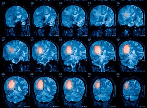 Fluorescence Can Id High Grade Glioma During Sx For Brain Tumor