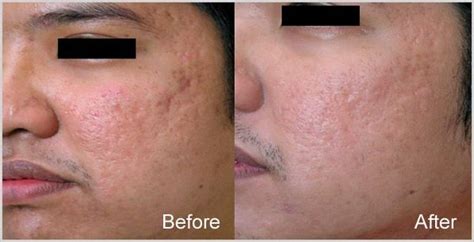 Dermaroller Before And After Derma Roller Derma Rolling Skin Problems