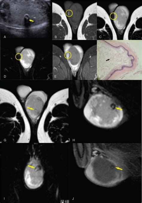 Mri Findings Of An Atypical Testicular Epidermoid Cyst A Ca Medicine