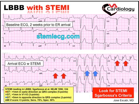 Mastering Stemi Ecg