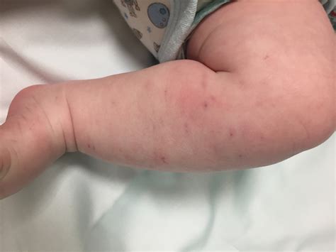 Meningitis Viral Rash Baby Rashes In Babies And Children Nhs Just