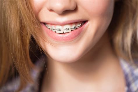 Metal Braces Vs Invisible Braces Whats Better For You Stuart Curry Dmd