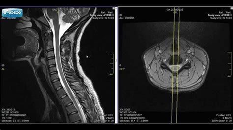 Mri Of The Cervical Spine Anatomy The Best Porn Website