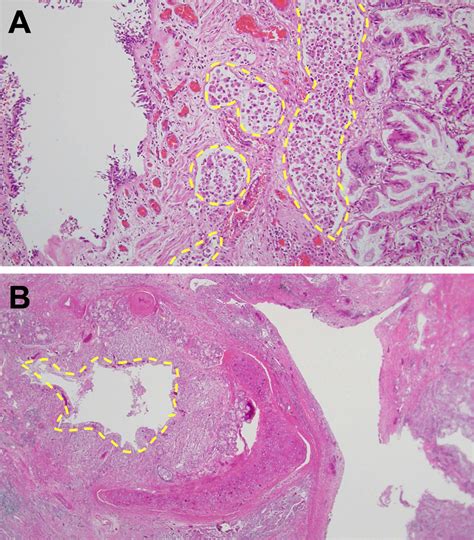 Cureus Invasive Mucinous Adenocarcinoma Of The Lung Presenting With