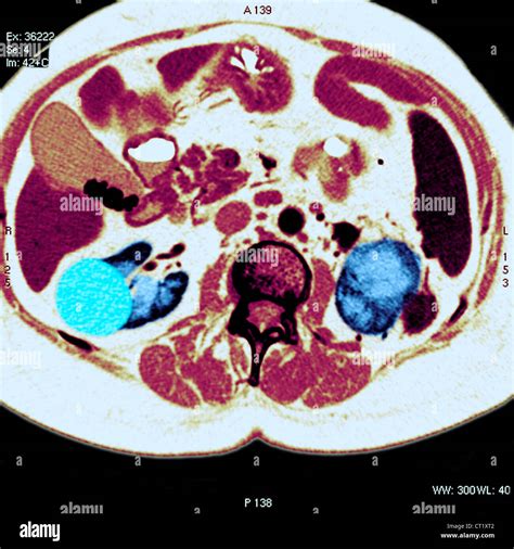 Cancer Of The Kidney Scan Stock Photo Alamy
