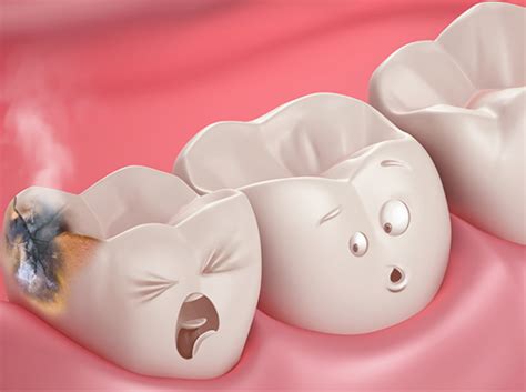 The Mythical Tooth Worms Dental Cavities Teeth Gambaran