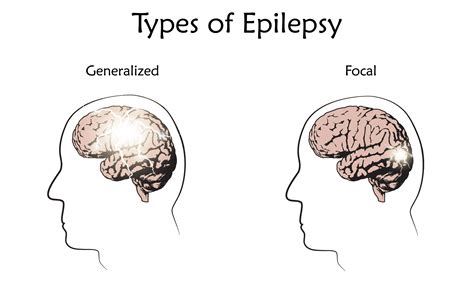 What Are The Different Types Of Seizures Epilepsy Queensland