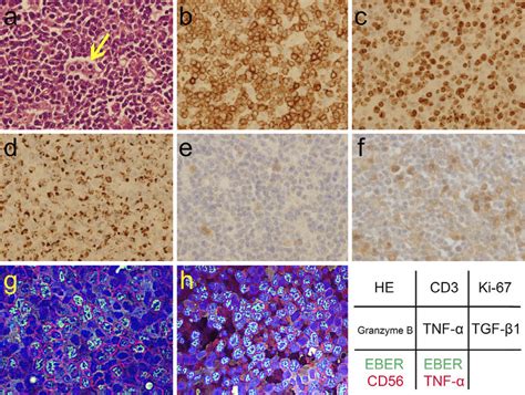 Figure1the Pathology Of The Nk Cell Neoplasm With Lymphoma Associated