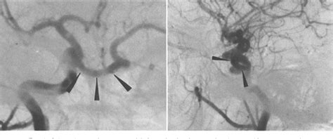 Figure From Transsellar Intracavernous Intercarotid Collateral Artery Associated With Agenesis