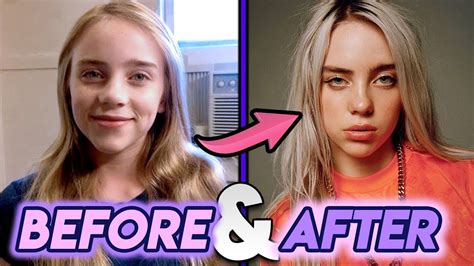 Billie Eilish Plastic Surgery Before And After Lips Nose Job Body Images