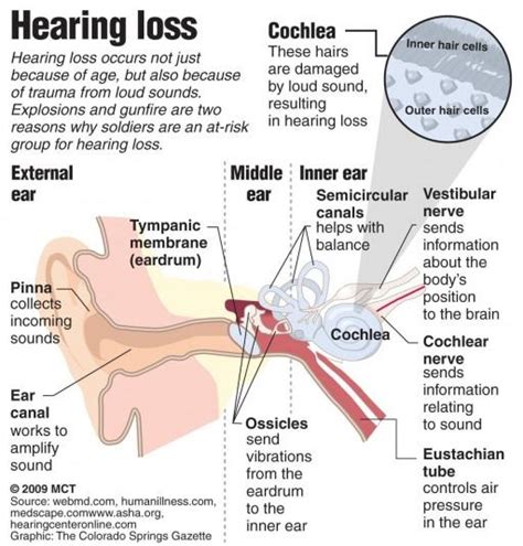 This type of hearing loss implies that you have damaged the tiny hair cells in the inner ear or the nerve that transmits sound to the brain or the brain itself. Sudden Deafness: Sudden Sensorineural Hearing Loss ...