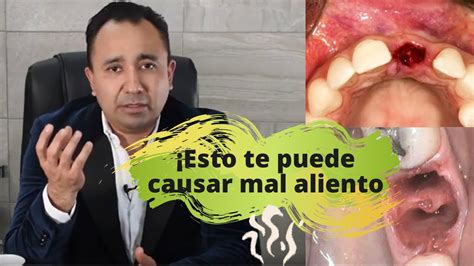 ¿infección Tras Extracción Dental ¿qué Es La Alveolitis Seca Youtube