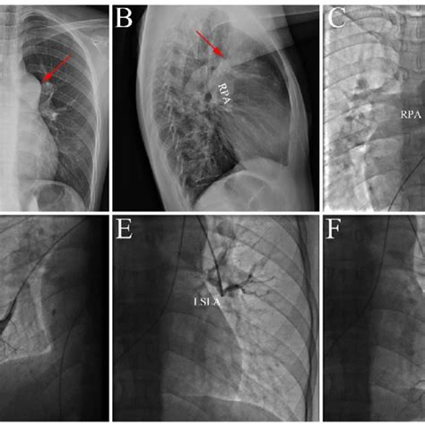 The Representative Image Of Pah Asd A And B Chest X Ray Showed