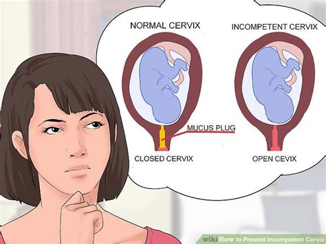 How To Prevent Incompetent Cervix 11 Steps With Pictures