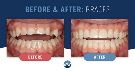 Before And After Braces See The Amazing Results Yourself • Woodhill